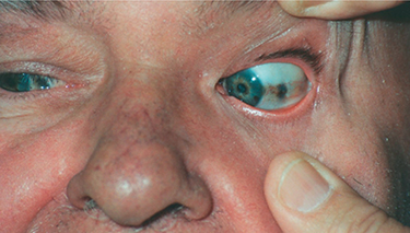 Oko s modro-šedo-čiernymi škvrnami na očnom bielku